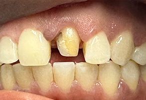 Smile Dental Spa | Air Abrasion, Dental Fillings and Pediatric Dentistry